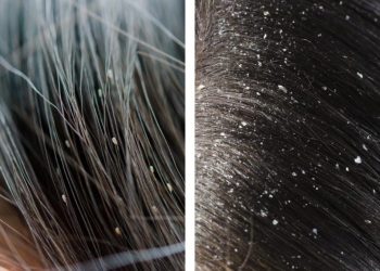 चिसोमा बढिरहेछ चायाँको समस्या, यी हुन् घरेलु चार उपाय