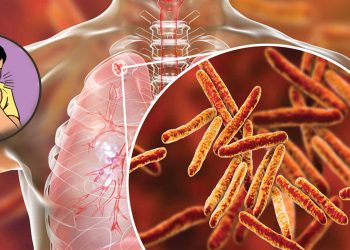 स्याङ्जामा एक सय ६० क्षयरोगी उपचारमा, पाँच जनाको मृत्यु