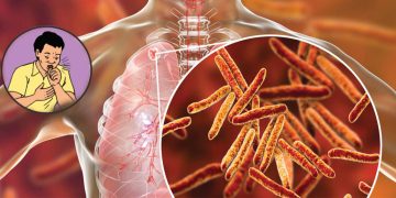 स्याङ्जामा एक सय ६० क्षयरोगी उपचारमा, पाँच जनाको मृत्यु